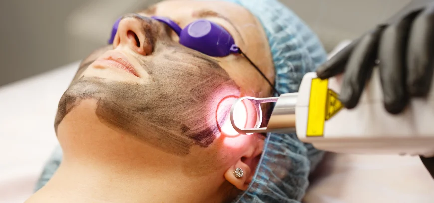 Carbon lotion on facial skin during preparation for a carbon laser peel