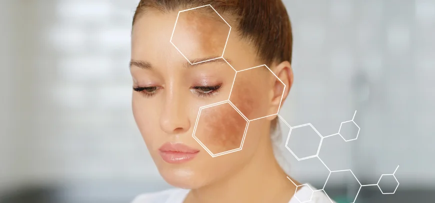 Dermatology consultation for freckles and sun spots at AB Skin Clinic in Hyderabad