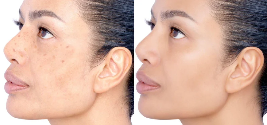 Cheek with patchy brown pigmentation examined before a laser consultation