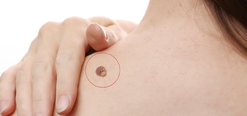 Wart examination and removal consultation at AB Skin Clinic in Hyderabad